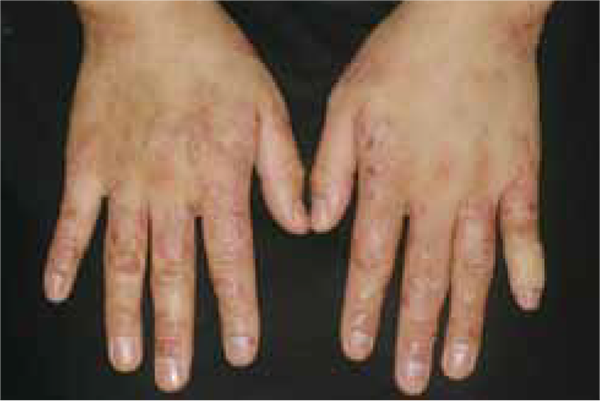 図10 -1　アレルギー性接触皮膚炎